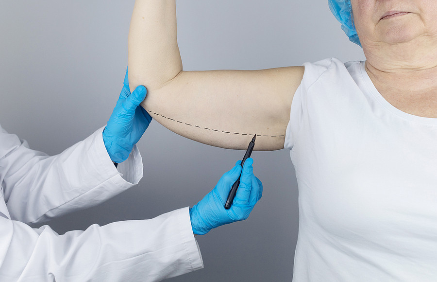 dangling skin at the elbow. An older woman shows the surgeon problem areas of the forearm. Examination before cosmetic surgery. An example of a good candidate for an arm tuck.