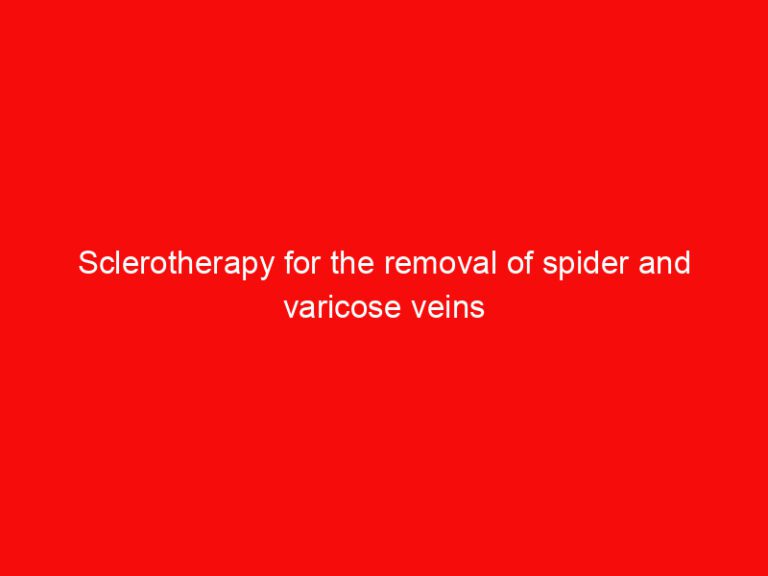 Sclerotherapy for the removal of spider and varicose veins